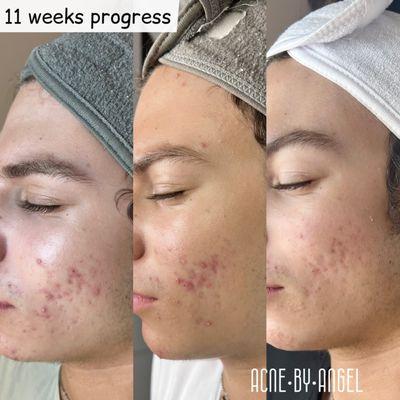 This is our Acne treatment result 11 weeks of treatment.