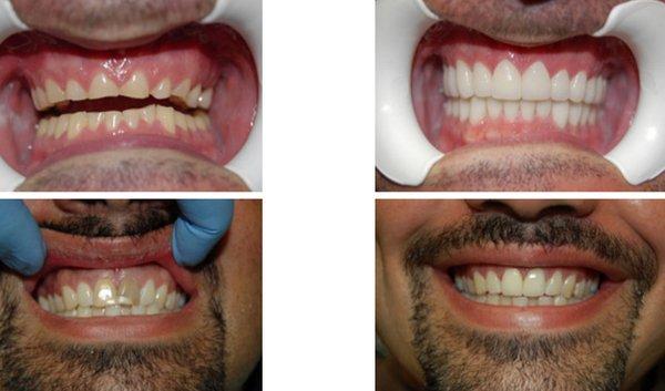 Dr. de Cardenas offers a wide range of services, including full mouth reconstruction and veneers.