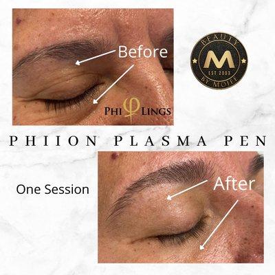 Plasma Pen Fibroblast- lift and remove saggy eyelids and under eye bags and wrinkles. Non surgical blepharoplasty - Phiion technology