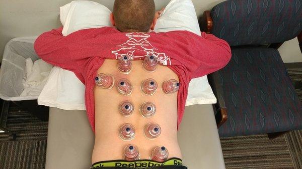 Cupping