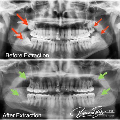 Patient is suffering from wisdom teeth impacted. All four wisdom teeth extracted. #oralsurgery #wisdomteethextraction