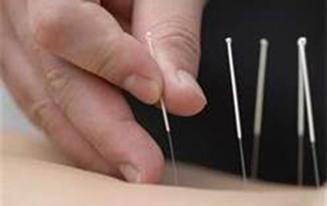 Dry Needling is a specialized treatment technique that uses thin filament needles to treat various musculoskeletal disorders.