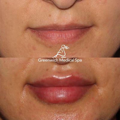 Your solution to fuller lips may include Restylane Kysse, Juvéderm Ultra XC, Volbella, or BOTOX injections.