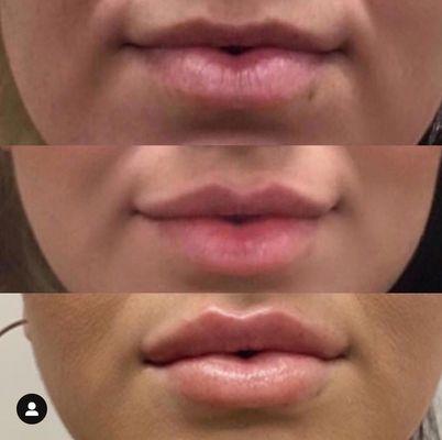 Lip Filler We used Restylane Defyne for her to give a more defined pouty appearance!