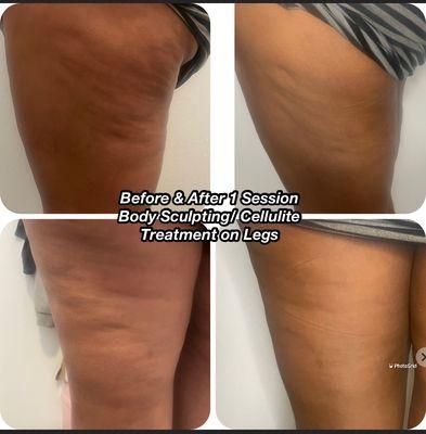 Body Sculpting/Cellulite Treatment on Legs