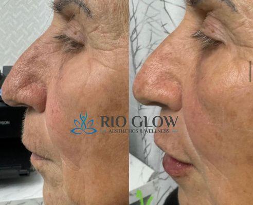 non surgical nose job with filler and lip injections