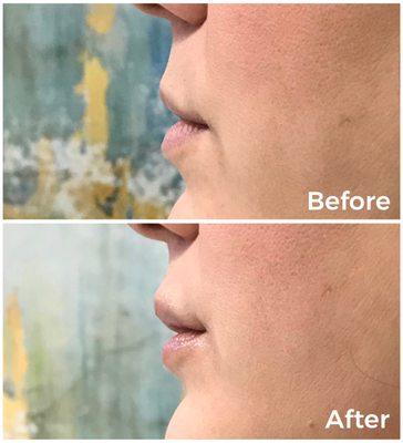 Fuller, softer lips with just one syringe of lip filler. Service performed at Ashtoria by Angie Boscaccy, RN.