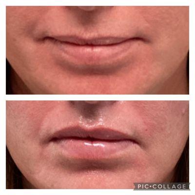 lip filler before after