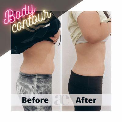 Body contouring