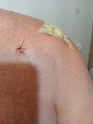 Sutures after surgery.