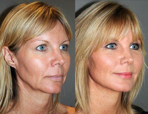 Laser series of 12 sessions  RF Refirme Wrinkle Reduction Laser skin rejuvenation