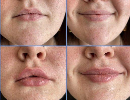 Another set of lips before and after!! We love what we do!