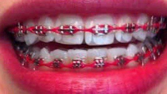 My amazing braces