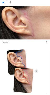 Blue and red lines show where incisions are typically placed to be well hidden.