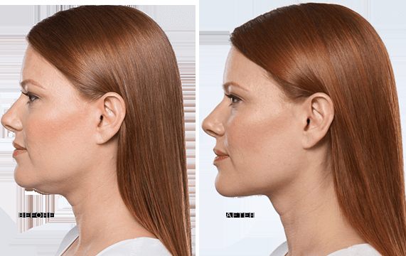 kybella