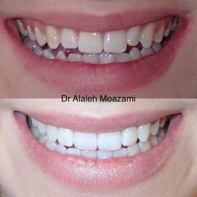 Invisalign Clear Braces (4 months start to finish)