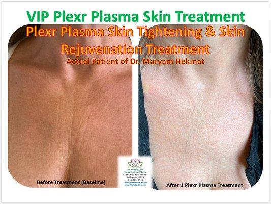 Skin rejuvenation and tightening with Plexr plasma