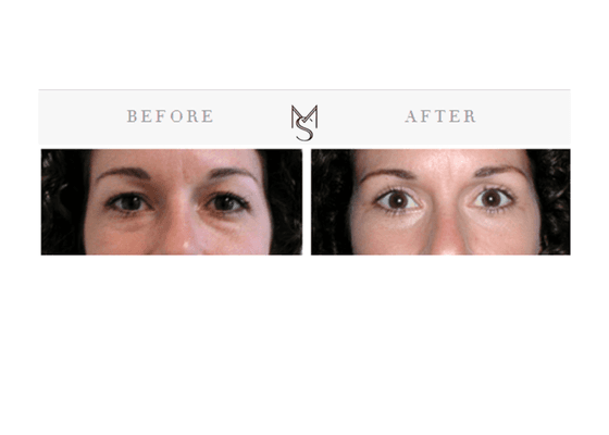 Upper & Lower Eyelid Surgery (Quad Blepharoplasty)