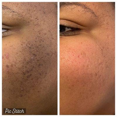 Dark spot Treatment with Pore clearing and Skin Texture improvements