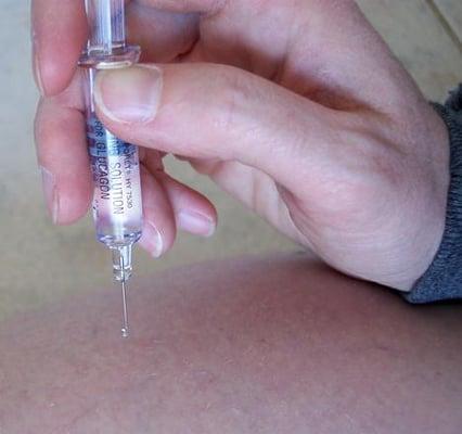 Josh Zimmer, AP/DOM is certified to perform injections into acupuncture points with homeopathics and liquified herbs.