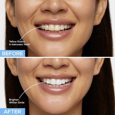 Professional In-Office Whitening!

Quick, Painless and Beautiful results in under an hour!