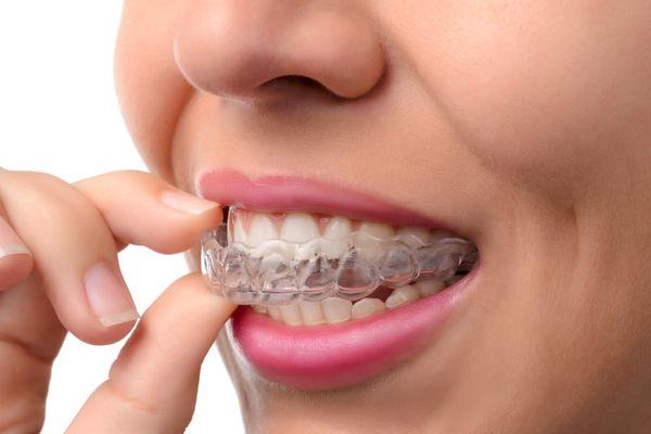 Clear Aligner Treatment (Invisalign)