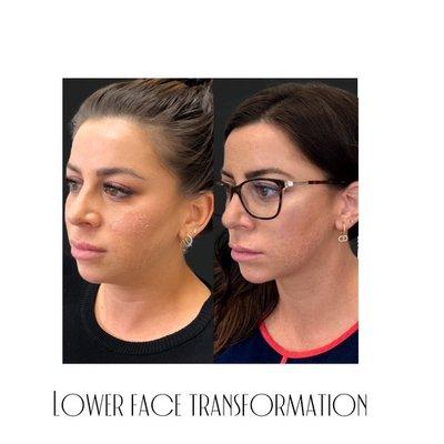 Lower face transformation