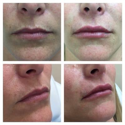 Our nurse injector Alexis Hudson works wonders with FDA approved Fillers and Botox.