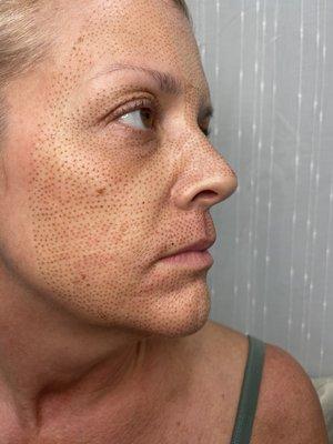 Full face rejuvenation, even out skin tone and reducing sun spots