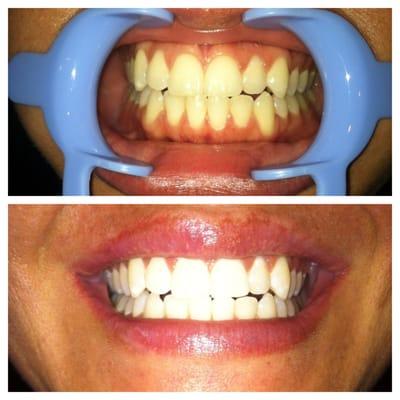 40 minute laser teeth whitening session