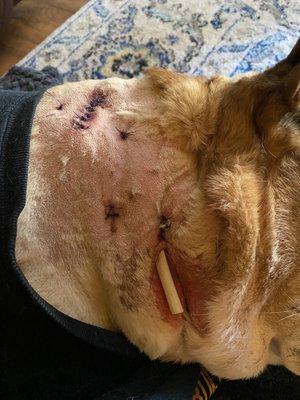 Phot of neck wounds with sutures and drain tube.