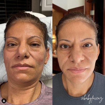 Beautiful results of Bellafill filler in Scottsdale