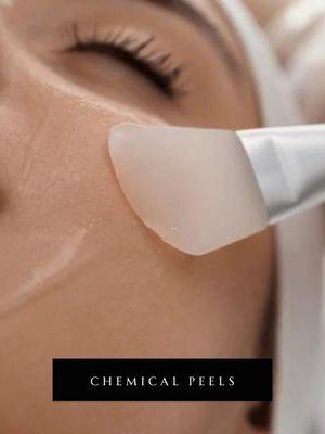 Chemical Peels.