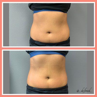 This was accomplished in only one hour, client's waist got smaller by 1 inch. We can't wait for end results!