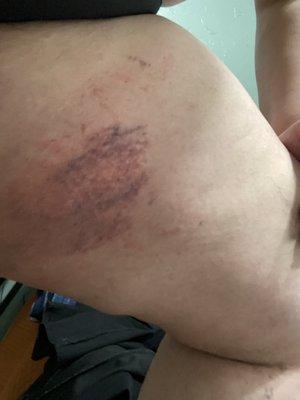 Bruise after wax.  The older lady repeatedly mentioned it would "go away" in 30 minutes.