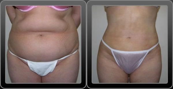 Liposuction Before & After