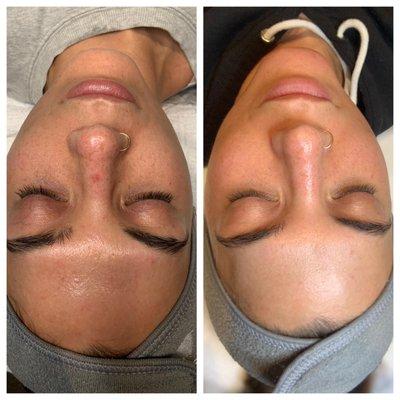 Amazing result after one chemical peel with Sam.