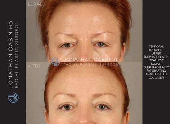 1 year post-op from full upper facial rejuvenation including brow lift, upper and lower eyelid lift, fat grafting and CO2 laser resurfacing.