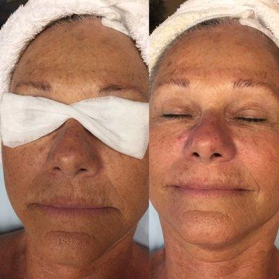 Before and after a Microdermaplaning custom facial