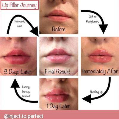 The journey of lip filler. First two weeks