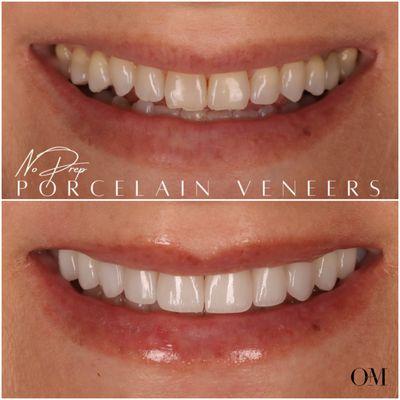 10 nearly no prep veneers to create more balance and brightness in the smile by Dr Joyce Kahng