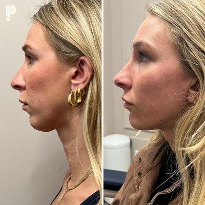 Chin Filler Treatment