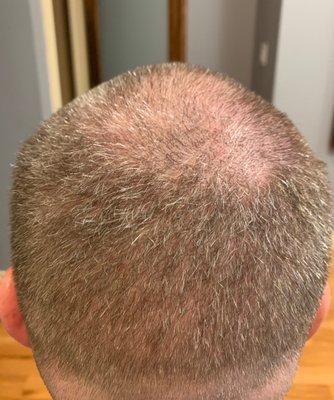 FYI: I'm not bald. I have no male pattern baldness, and no "crown" of baldness. It's the haircut I received a couple hours earlier.