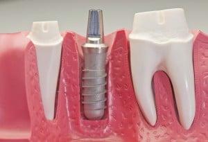 Dental implant!!! One of the ways to replace a missing ooth!!