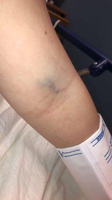 arm after IV