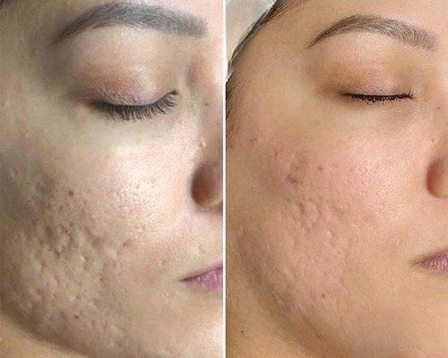 Microneedling