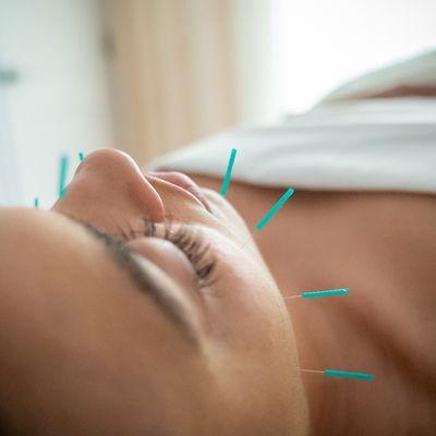 Acupuncture facial rejuvenation.