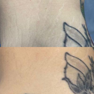 Stretch marks Inkless