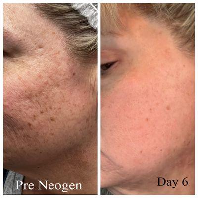 Neogen Client with acne scars and discoloration