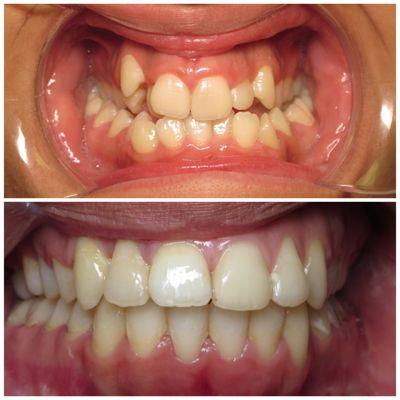 Wow! Wow! Wow! Now that is one beautiful, healthy smile!! Can you believe this was achieve by Dr. Alborzi with Invisalign!?